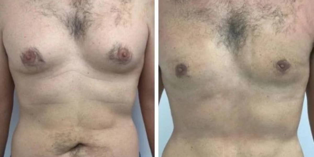 How to Track Progress After Gynecomastia in Dubai
