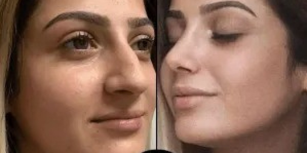 Why PRP Treatment in Dubai Is Gaining Global Attention