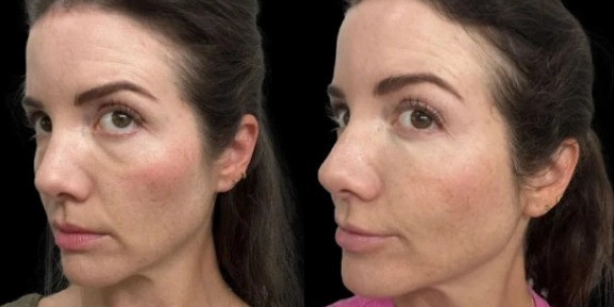 Long-Lasting Dark Circles Treatment by Best Aesthetic Clinics in Dubai