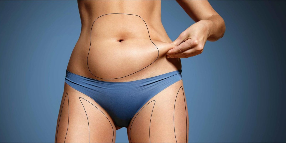 Abdominoplasty in Dubai: How to Maximize Your Results and Maintain a Flat Stomach
