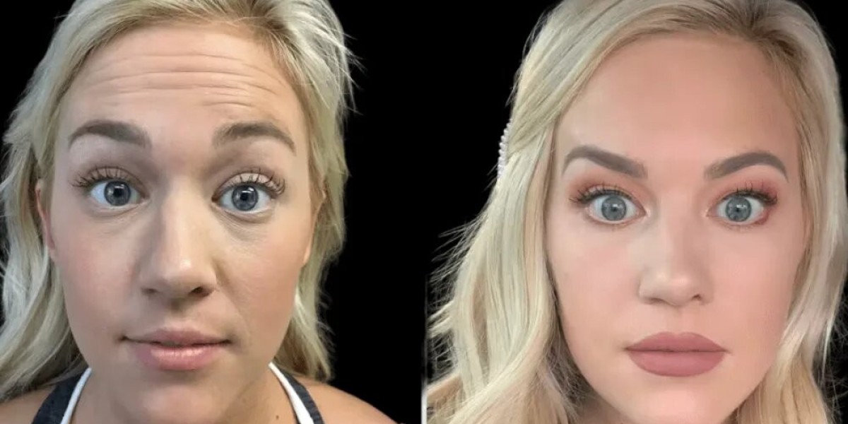 Are You a Good Candidate for Botox in Dubai? How to Know