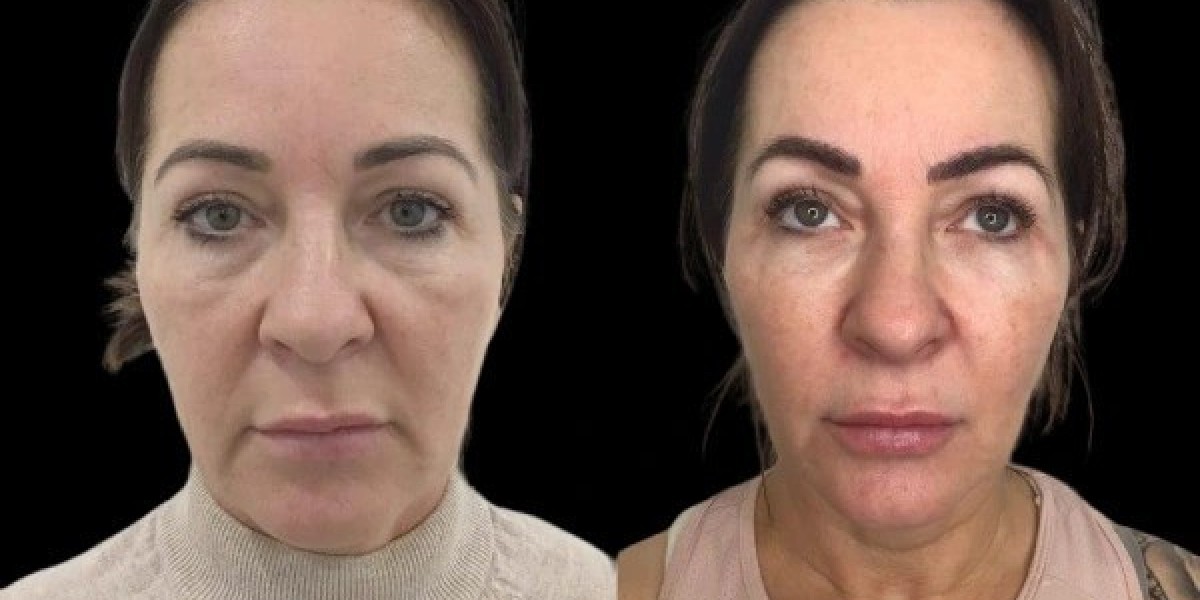 Profhilo Benefits for Anti-Aging Best Aesthetic Clinics in Dubai