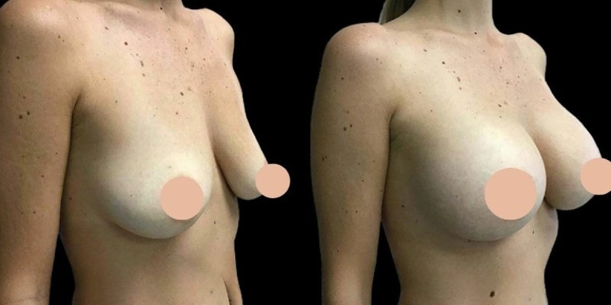 Best Breast Augmentation Surgeons in Dubai on the Latest Surgical Techniques